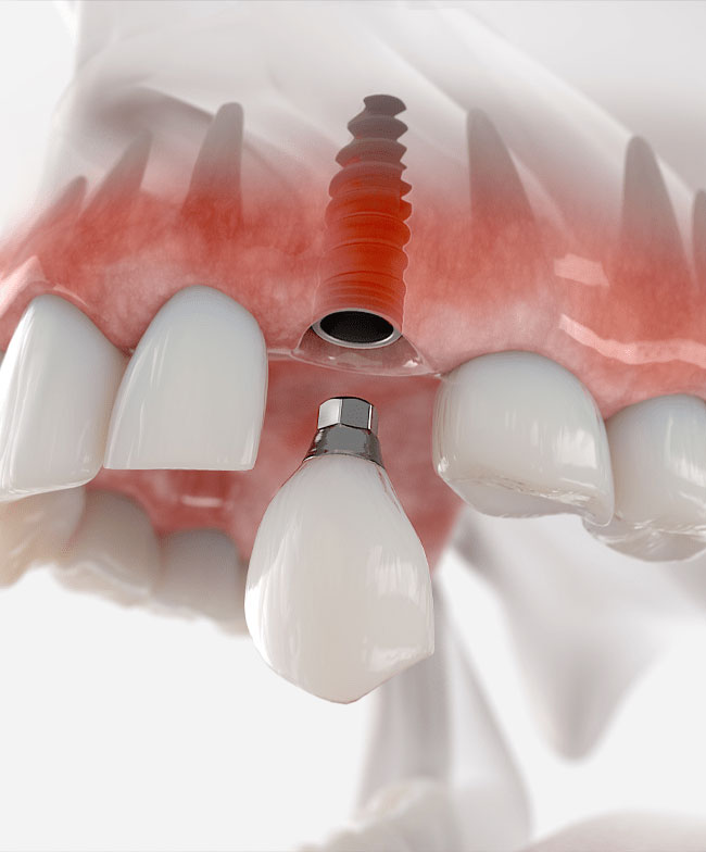 Dental implant procedure and tooth restoration